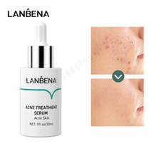 SUREYOULiKE Acne Treatment Serum Anti-Acne Serum Salicylic Acid 여드름 세럼 LANBENA 안티-여드름 세럼 위드 살리실산