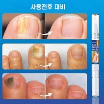 발톱무좀치료 발톱무좀약 손발톱 네일 리페어 강화 에센스, 3ml, 2개