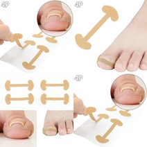 내성발톱 교정테이프 내성발톱관리 내성발톱밴드