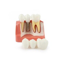 GM16 임플란트 설명 모형 4배크기/ 임플란트 와 크라운 브릿지 비교 치아 교육 환자 설명 모형 치과 장식 장식품