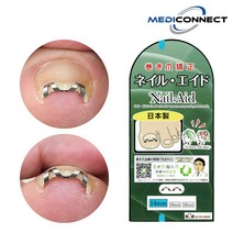 메디커넥트 내성발톱 교정기 내향성발톱 치료 파고드는발톱 교정, 2개