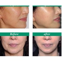 얼굴 리프팅 기계 마사지기 미용기기 입술 주사기 보톡스 필러 3D 조각 LED 조명 사인 소매 메디, 10 Inibo 100u