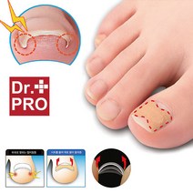 일본아이디어쇼 닥터프로 3중구조 엄지발톱 테이프, 베이지, 1세트