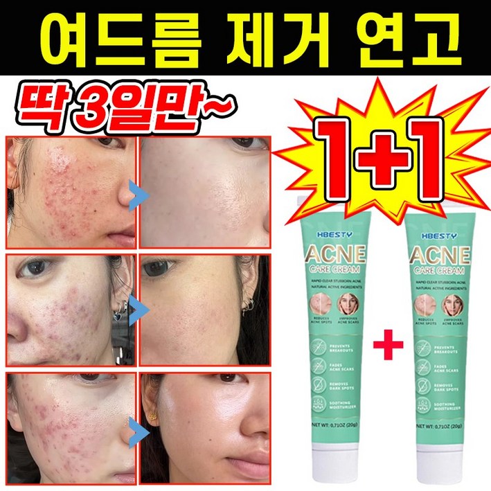 [국내 배송] 1+1 여드름 제거 연고 모낭염 흉터 제거 연고 재생 크림 피부 미백 케어 크림